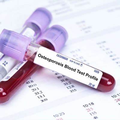 Osteoporosis Blood Test