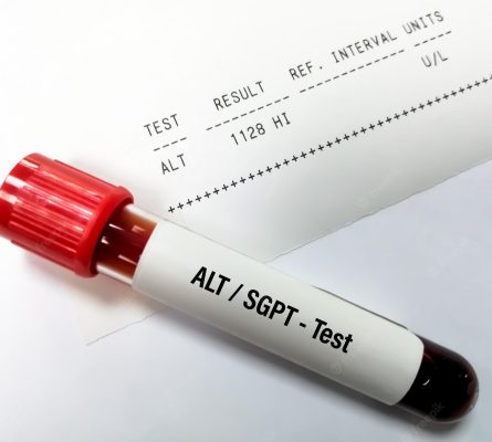 Alanine Aminotransferase (SGPT) Blood Test