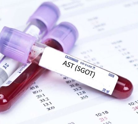 Aspartate Transaminase (AST) Blood Test