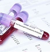 Antineutrophilic Cytoplasmic Antibody (ANCA) Blood Test