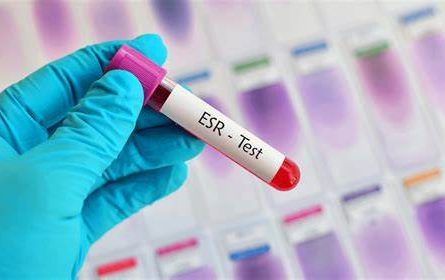 Erythrocyte Sedimentation Rate (ESR) Blood Test