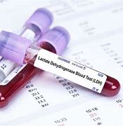 Lactate Dehydrogenase Blood Test