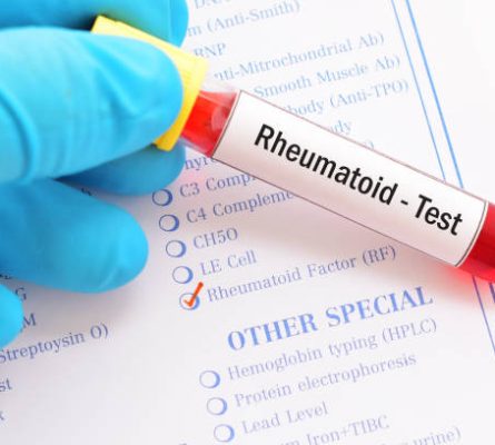 Rheumatology Profile 2 (Connective Tissue) Blood Test