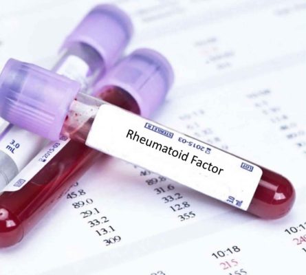 Rheumatology Profile 6 (Rheumatoid Plus) Blood Test