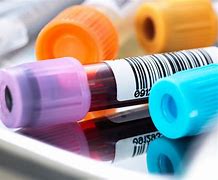 haemoglobin electrophoresis (sickle cell)